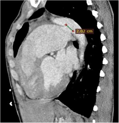Case report: Thoracic endovascular aortic repair using a non-touch exclusion technique with a custom-made device for the treatment of a large patent ductus arteriosus